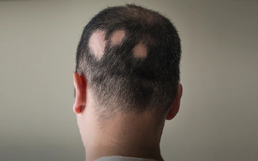 Types of Alopecia