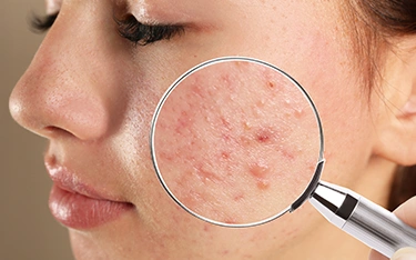 Acne vs. Pimples