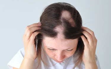 Can alopecia areata affect women?