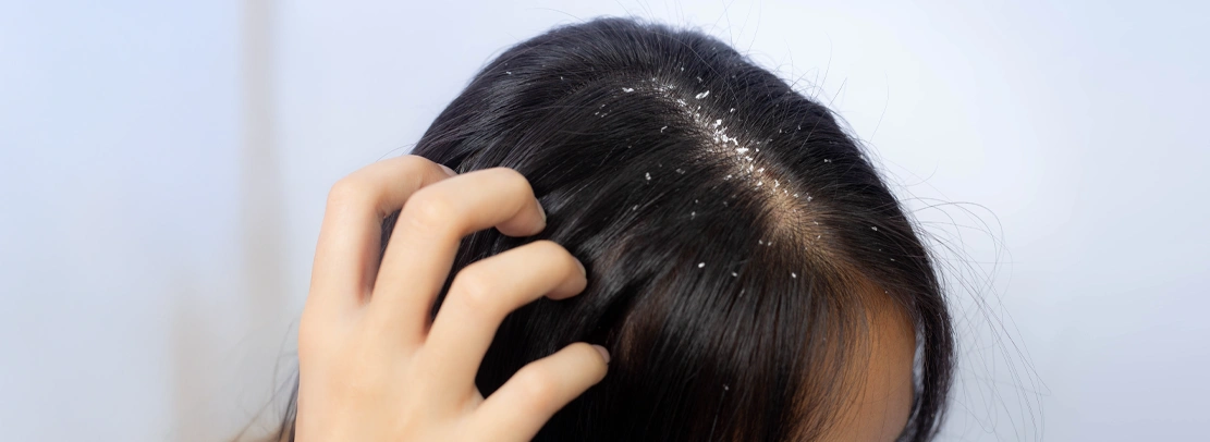 dandruff