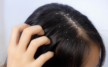 Can dandruff cause hair fall?