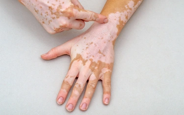 Can Vitiligo Make You Completely White? Understanding the Condition