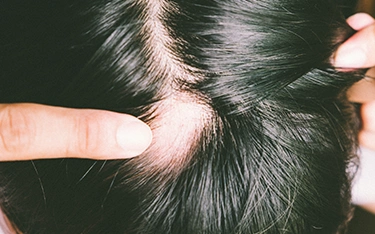 Is castor oil good for alopecia areata?