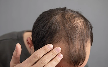 Causes and Treatment of Scarring Hair Loss