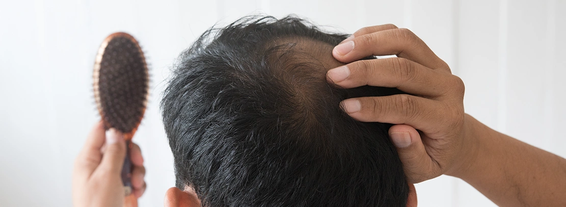male pattern baldness