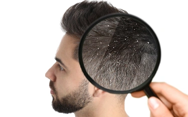 Don’t let dandruff ruin your relationship
