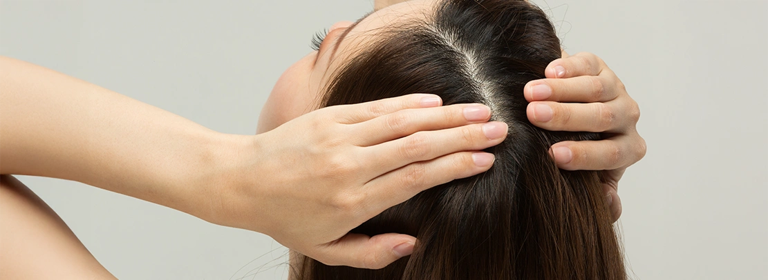 female pattern baldness