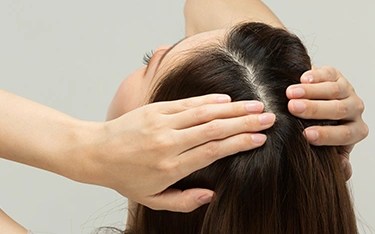 Female Pattern Baldness in 20s – Causes, Symptoms & Best Treatments