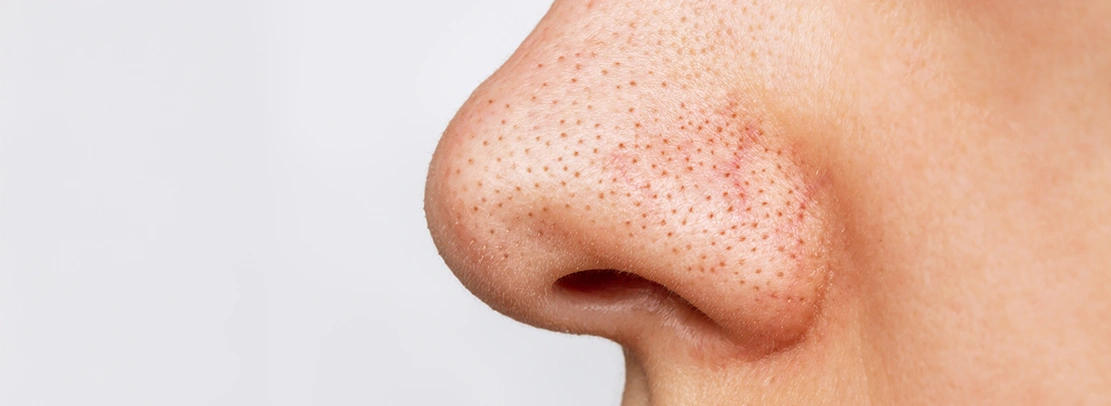 acne