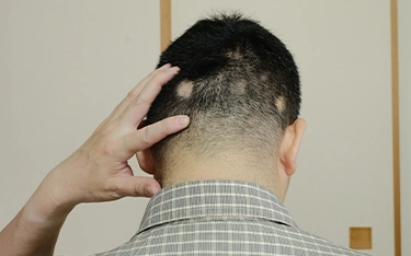 Causes of Alopecia Areata: Understanding the Triggers & Risk Factors