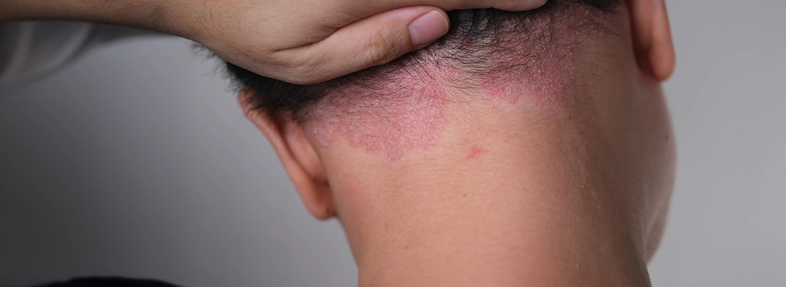 psoriasis
