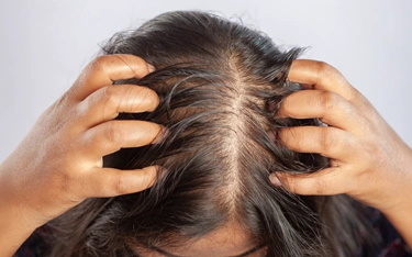 Can hair fall in women occur in the 30s?