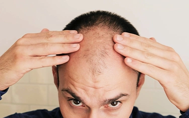 Understanding Male Pattern Baldness: Find Answers & Hope for Hair Health