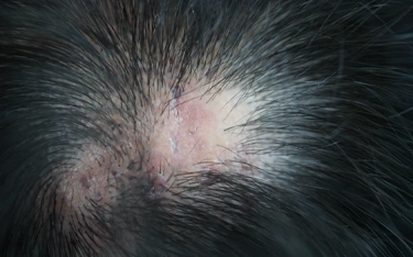 Lichen planus and hair loss