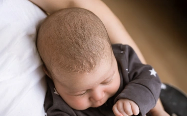 How does Seborrhoeic Dermatitis affect babies?