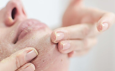 How to remove dead skin from face