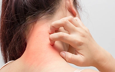 How to Remove Fungal Infection Marks from Skin