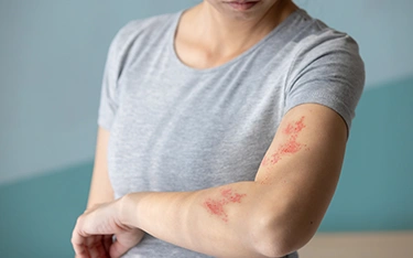 How to treat and get rid of hives