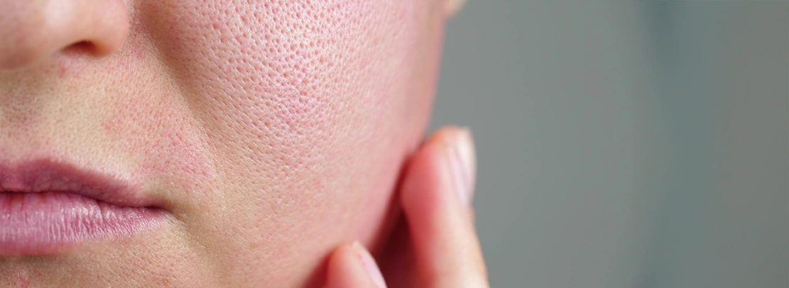 acne