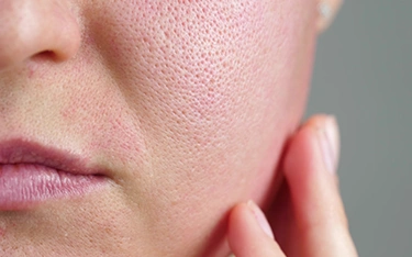 Large Pores vs. Acne Scars: Key Differences and Treatments