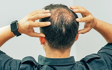 Know these stages of male pattern baldness