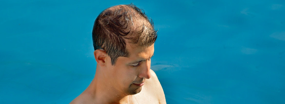 male pattern baldness
