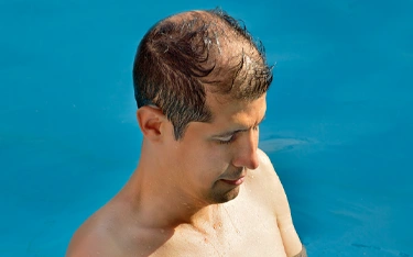 Why men experience hair loss in summer?