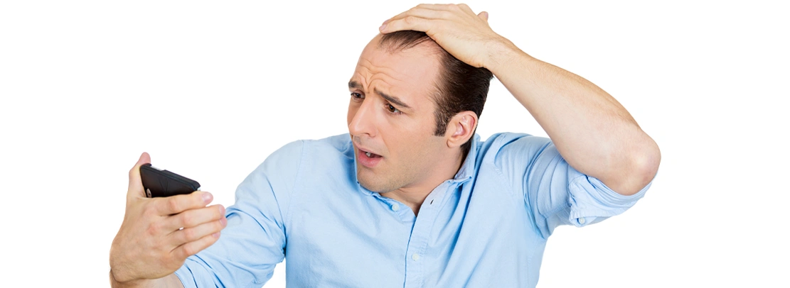 male pattern baldness
