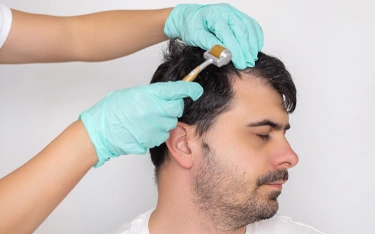 Mesotherapy for Hair Loss and Hair Growth