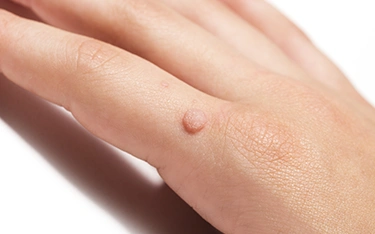 What are Genital Warts?