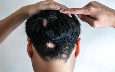 Symptoms of Alopecia Areata