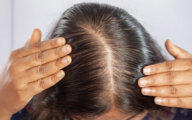 Female Pattern Baldness Symptoms