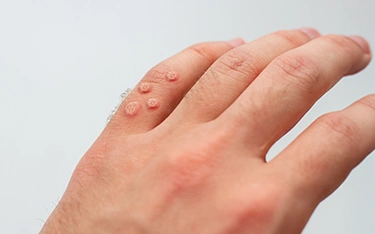 skin-diseaseswartscauses