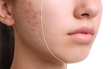 10 things you can do to treat acne