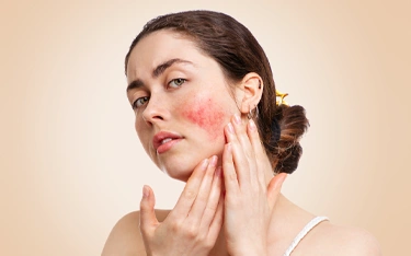 Rosacea vs Acne: How to Distinguish and Treat Each Condition