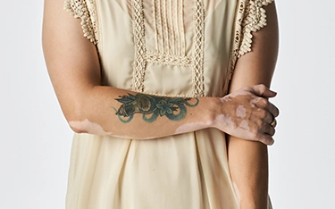 Is It Safe to Get a Tattoo If You Have Vitiligo?