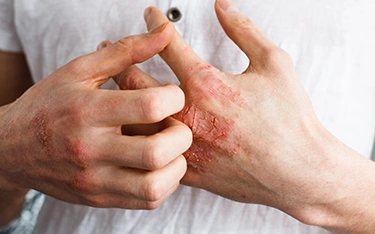 Dermatitis