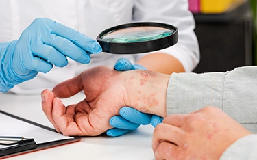 skin-diseases-eczema-symptoms
