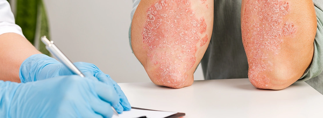 psoriasis