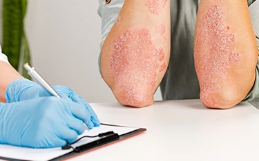 Types of Psoriasis: Understanding the Different Forms
