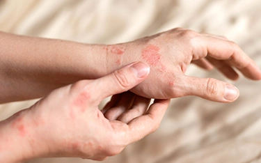 Eczema Types: Understanding the 7 Common Forms & Their Symptoms