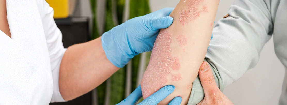 psoriasis