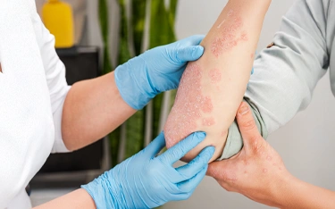 Types of Psoriasis: Understanding the Different Forms