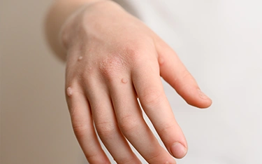 Types of Warts: Identification and Treatment
