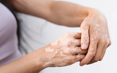 Skincare tips if you have vitiligo