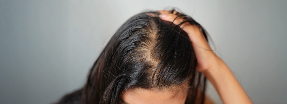 female pattern baldness