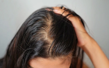 Stages of Female Pattern Baldness: Causes, Symptoms & Treatments