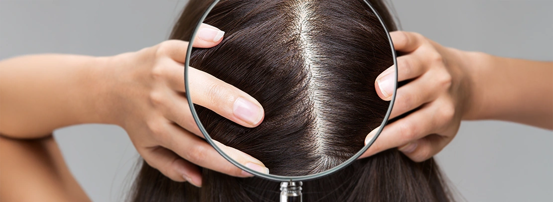 hair fall