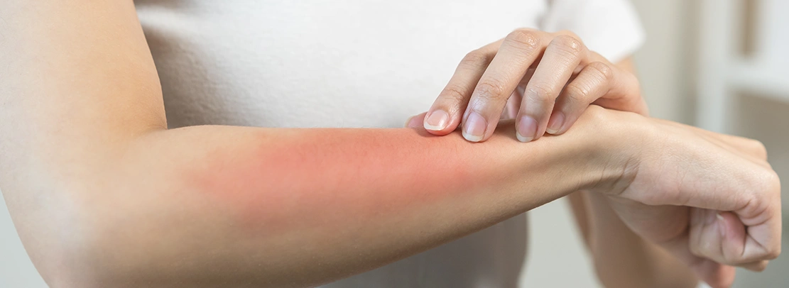 Treat Summer Skin Problems with Homeopathy