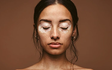 Understanding Vitiligo in Children